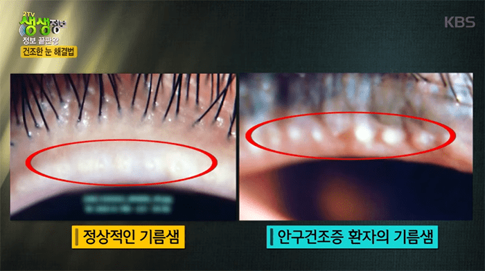 안구건조증 증상 및 원인 해결, 자가 진단 치료 방법
